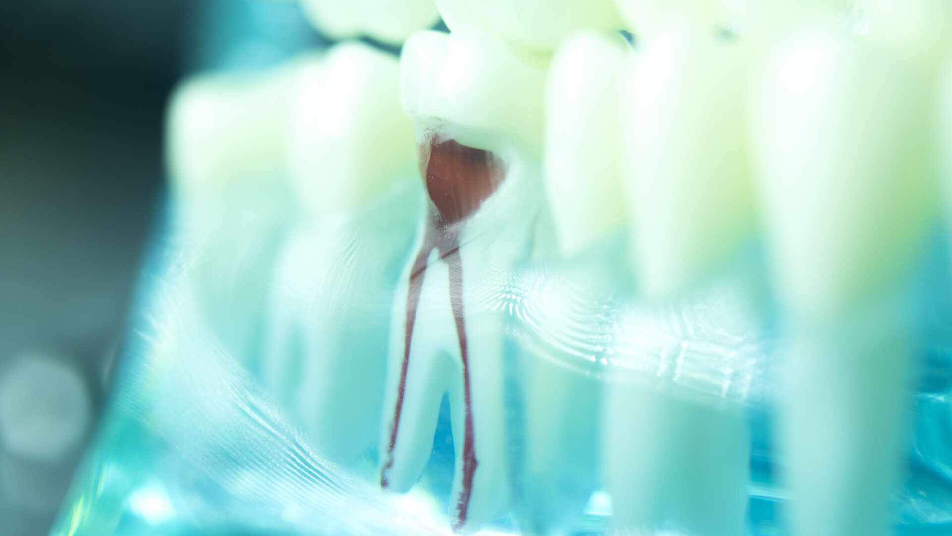 The access cavity in endodontics: Three rules for a predictable outcome in complex cases