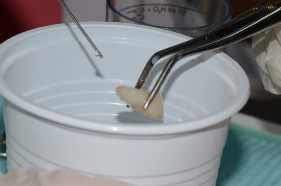 Figure 5a. Avulsed 21 with open apex was irrigated with saline as soon as the patient arrived to the clinic. Notice the tooth was held without touching the root to preserve the PDL tissue