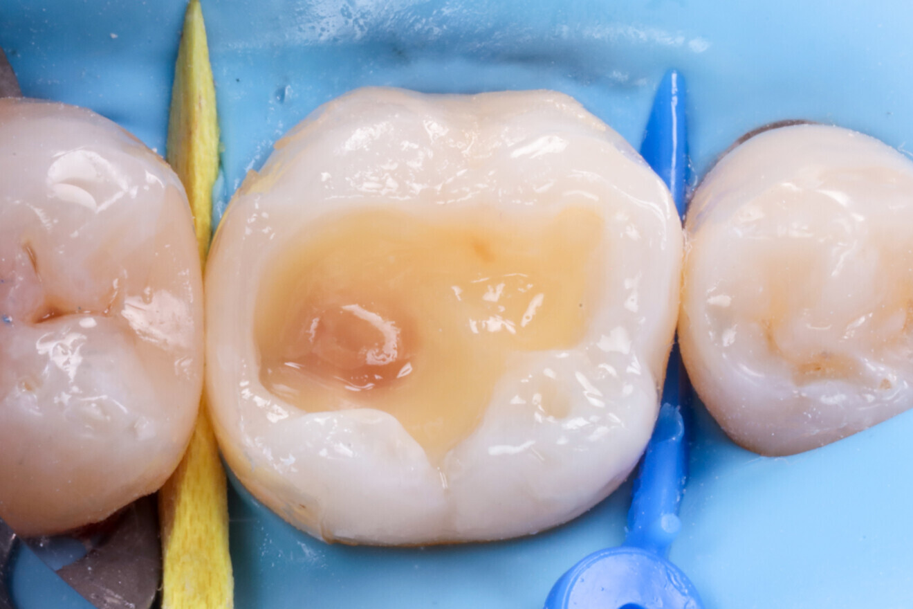 Fig. 9: Undercuts filled with a short-fibre-reinforced composite.