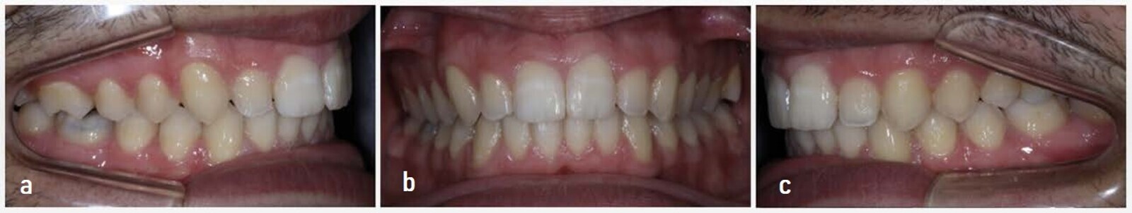 Figs. 16a–c: Final results one year and seven months later. 