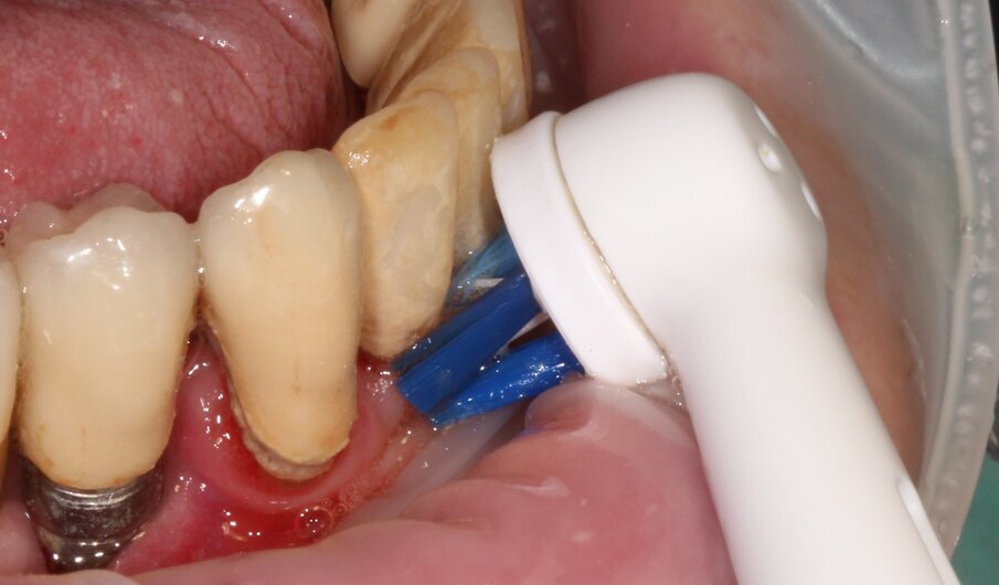 Fig. 3 - Testina Targeted Clean con inclinazione a 45°.