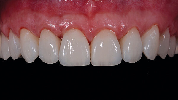 Fig. 16f. Resultado final inmediatamente después de retirar dique de goma.