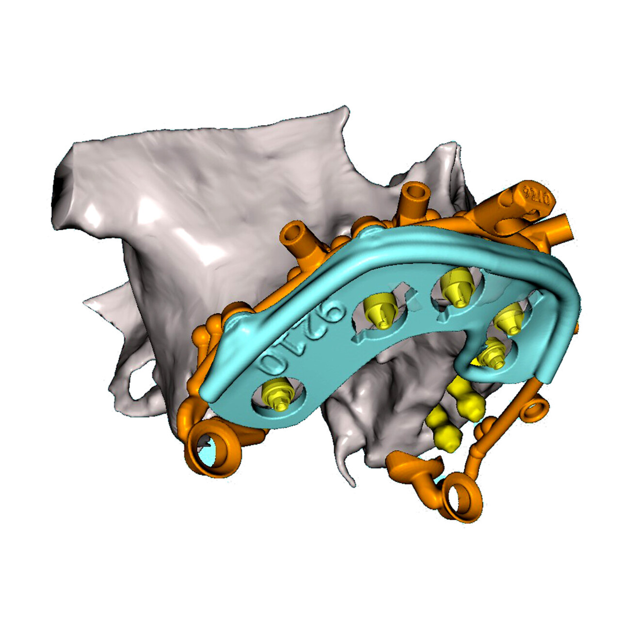 Fig. 11b: Oblique lateral view showing attachment of the jig to the base frame.