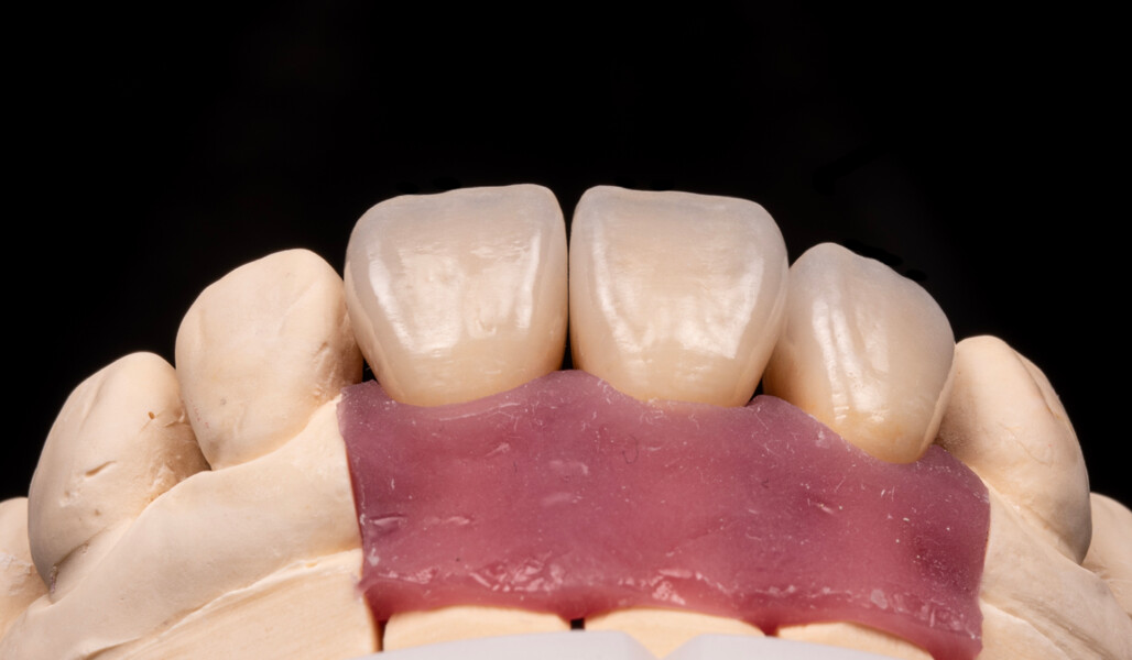 Fig. 9: Labial view of the crowns on the model, showing the natural appearance of the restorations.