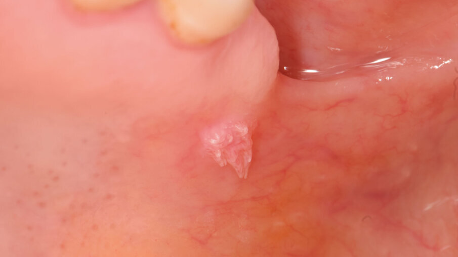 Fig. 1 - Lesione papillomatosa tra palato duro e molle in prossimità della tuberosità.