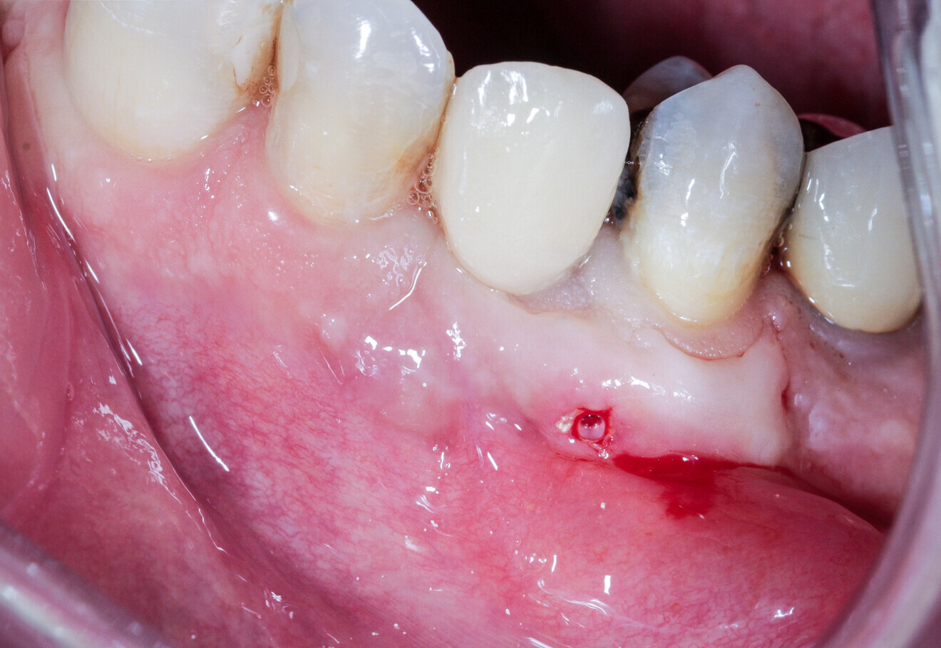 Fig. 20: The osteosynthesis screw was visible under the gingiva and was thus removed after six months.