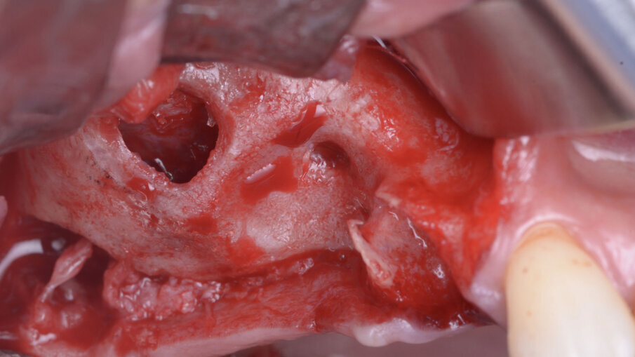 Fig. 4 - Opercolizzazione ossea e scollamento della membrana di Schneider.