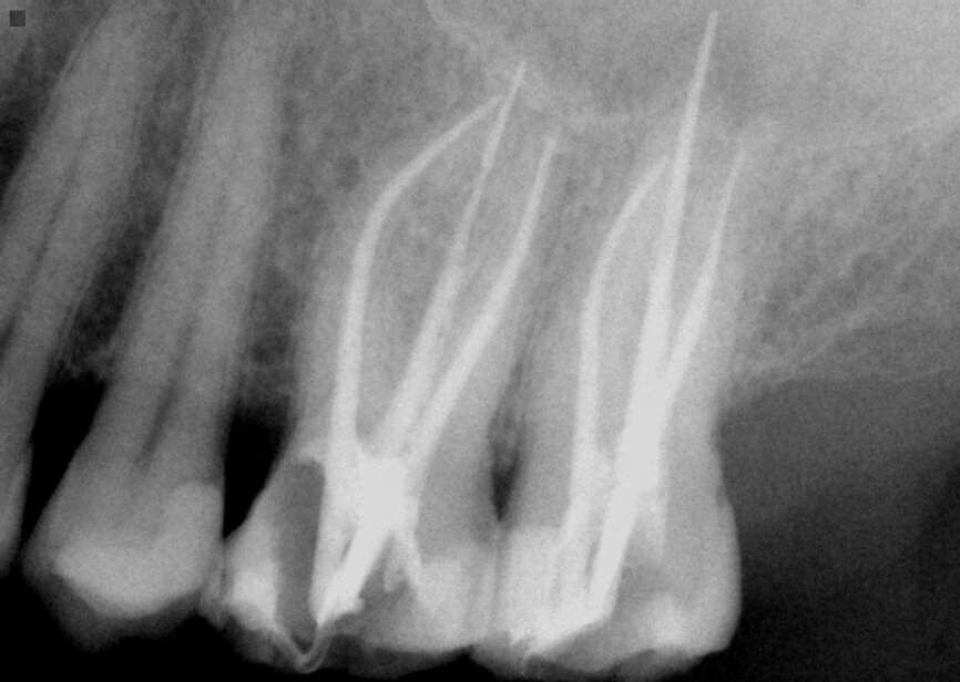 Fig. 15: Instrumentation performed with ExactTaperH DC files and obturation with a single cone of GP and Bioceramic Root Canal sealer completing endodontic treatment. 