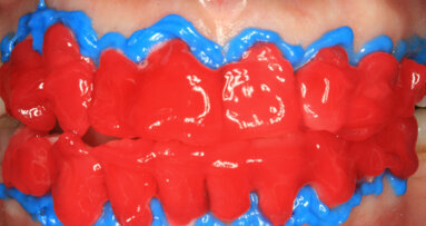 Protocollo clinico per il trattamento cosmetico di sbiancamento interno