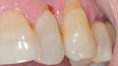 Utilizzo di metronidazolo topico nel trattamento  di siti con parodontite severa e perimplantite