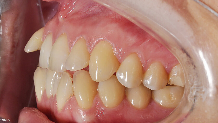 EIntraorální fotografie počátečního stavu pacientky.