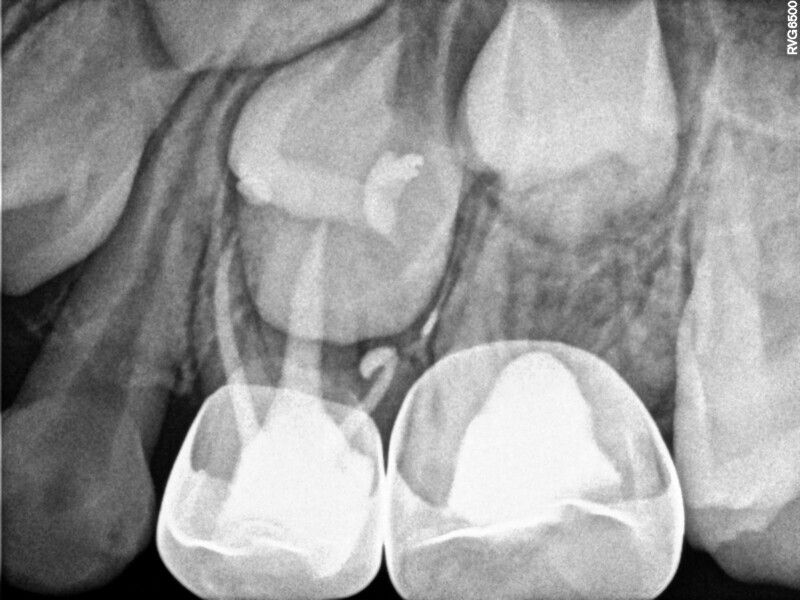 Fig. 22 : Contrôle à 30 mois montrant la cicatrisation osseuse autour de la racine mésiale et du tissu radiculaire distal.
