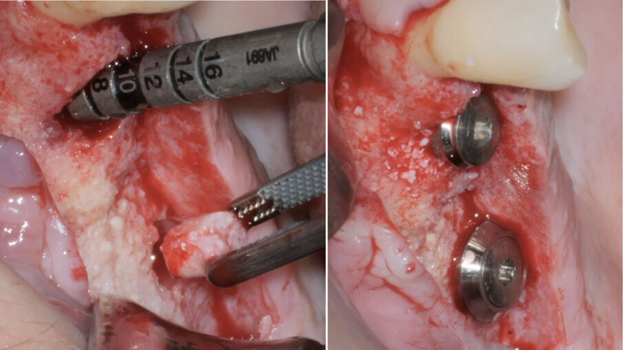 Fig. 12 - Prelievi bioptici ed inserimento implantare. 