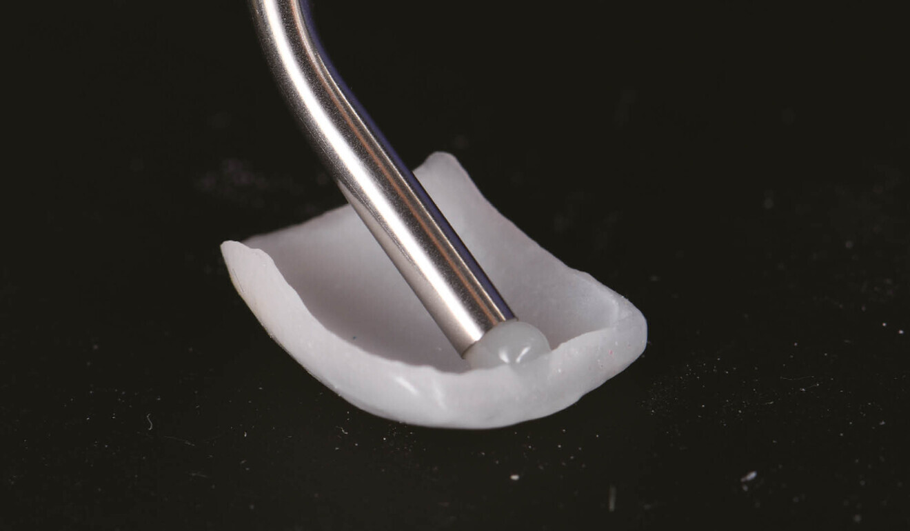 Fig. 5: PANAVIA Veneer LC in the clear shade loaded on to the prepared intaglio surface of a veneer.