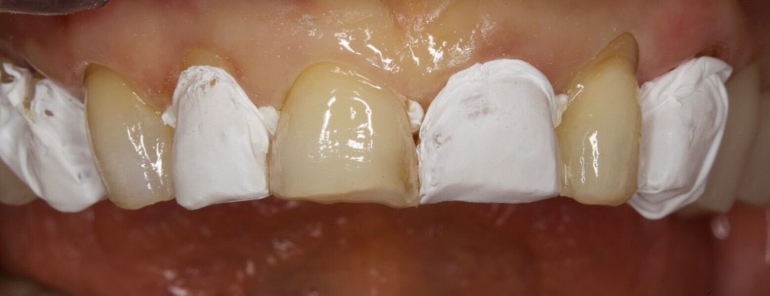 Fig. 11: Protection of the adjacent teeth with PTFE tape.