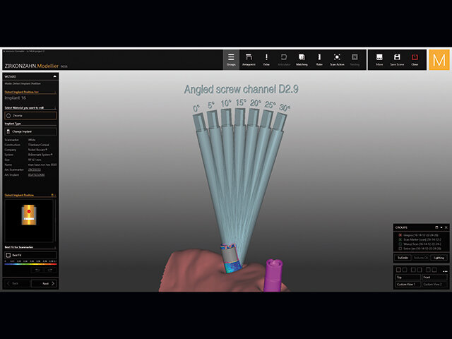 Při použití titanových základen K80 ASC je možné individuálně posunout každý kanál pro šroubek podle sklonu implantátu.