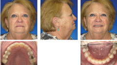 Case report: Advances in aligner treatment for open bites deliver stable correction