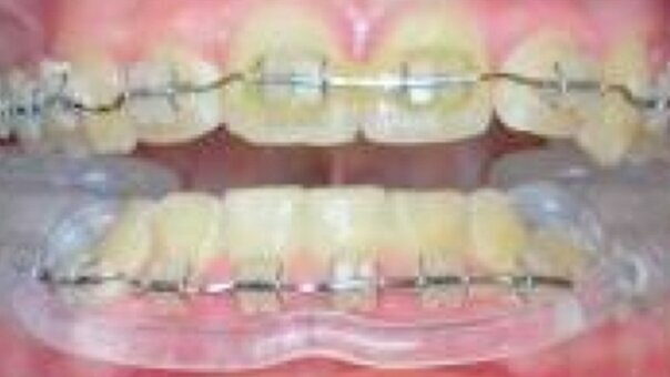 Diagnóstico y tratamiento de ATM con una nueva férula