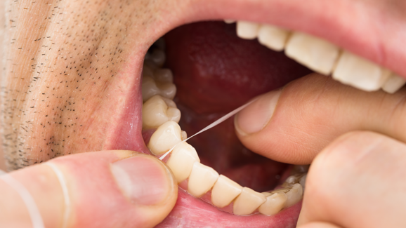 Effizienz von Zahnseide: EFP-Stellungnahme zu aktuellen Berichten