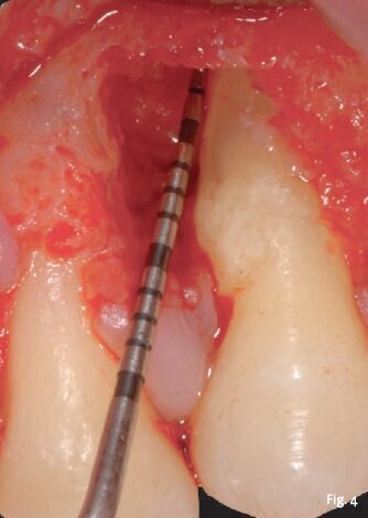 Fig. 4 - Evidenziazione del difetto, sondaggio intraoperatorio e perle dello smalto. 