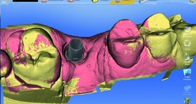 Cas clinique de couronnes sur piliers implantaires CFAO