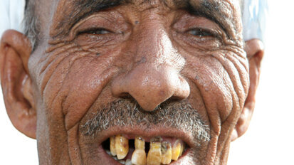 Ontbrekende tanden grootste afknapper