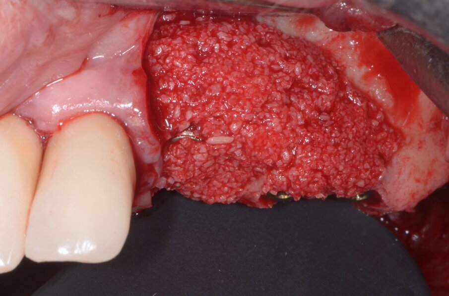 Fig. 8 - Innesto vestibolare di osso eterologo tipo PRF-block.