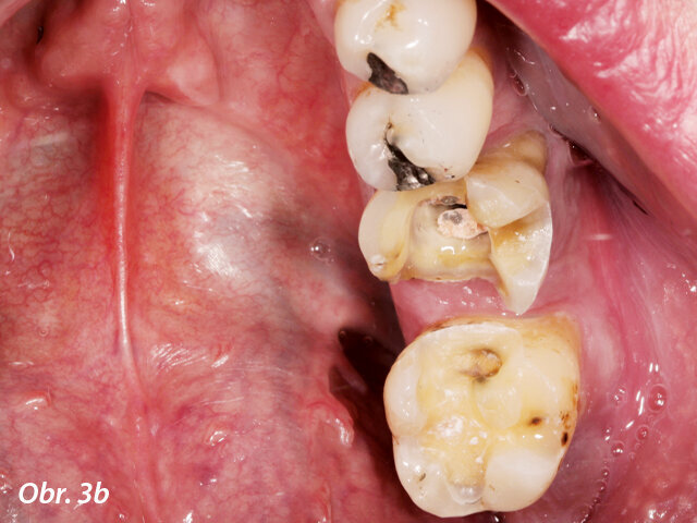 Preparované zuby jsou připraveny na intraorální digitalizaci (intraorální skenování).