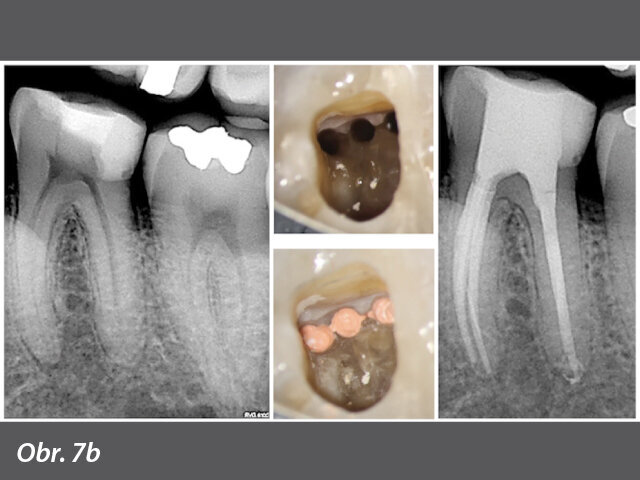Minimálně invazivní endodoncie, zachování obvodu koronárního dentinu a optimální apikální velikost (se svolením Dr. G. Debeliana)