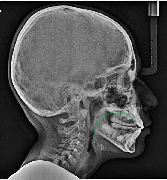 Fig. 14b: Comparison of the lingual position on the cephalometric radiograph at the (a) start (red line) and (b) end of treatment (green line).