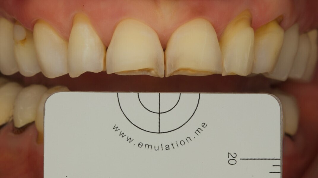 Fig. 4: Picture taken with a white balance grey reference card for objective shade quantification.
