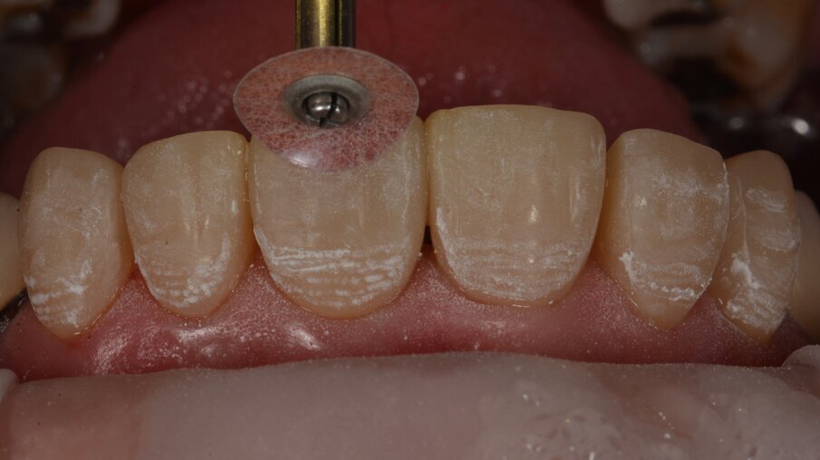 Verdere tertiaire anatomie kan worden aangebracht met een oud rood 3MTM Sof-LexTM Polijstschijfje op laag toerental.