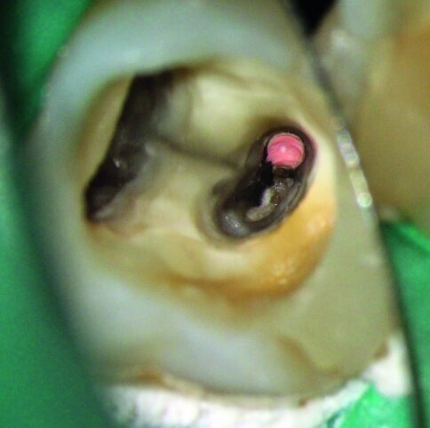 Fig. 1a: Debris left after root treatment of distal canal of a lower molar.