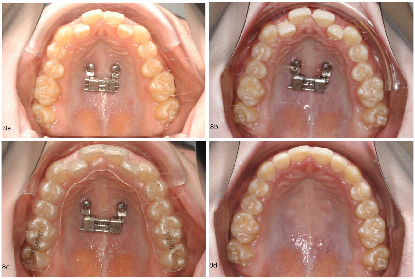 Figs. 8a–d: Treatment progress of a 13-year-old female patient with a severe maxillary transversal deficiency. (a) Insertion of two mini-implants in the anterior palate and the BMX expander. (b) Expanded maxilla after four weeks of activation. (c) Subsequent aligner finishing. (d) Result.