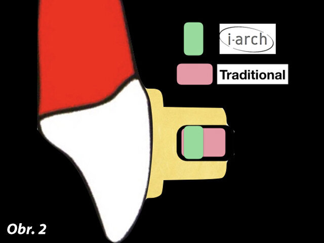 Inovativní čtyřhranný design i-Arch (zelený) proti tradičnímu oblouku čtyřhranného průřezu (červený), brání nadměrné protruzi klinických korunek zubů