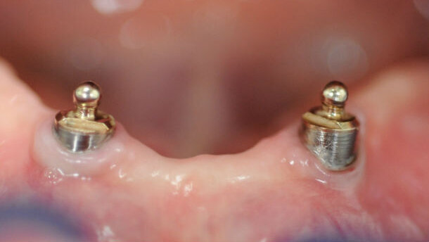 Riabilitazione di paziente già portatore di protesi con overdenture su due ball attachment preesistenti e usurate