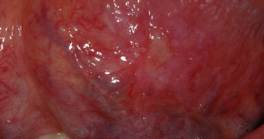 Prevenzione orale dei disordini potenzialmente maligni, uso della luce a fluorescenza