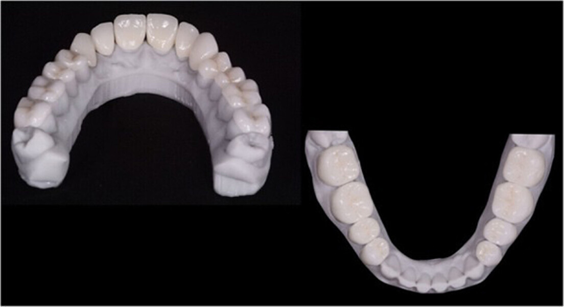 Fig. 12. Carillas y coronas finales preparadas digitalmente con el software de diseño Ceramill Mind y producidas en una fresadora (Ceramill Motion 2) a partir de bloques de cerámica de disilicato de litio mecanizables (VITABLOCS TriLuxe forte).