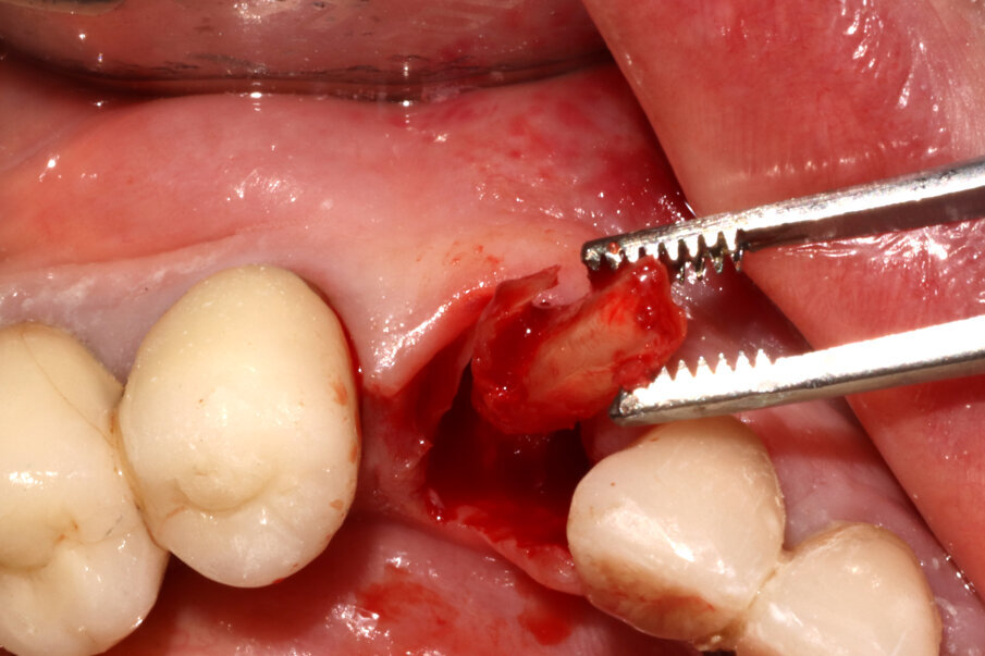 Figg. 5-7_Fasi della Socket-Shield: decoronazione, svuotamento del lume canalare e asportazione della porzione linguale della radice tramite protocollo “Preserving Nature”.