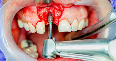 National standards for implant dentistry announced