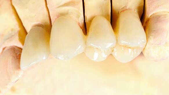 Study exploring accuracy of impression techniques finds partial vs. complete edentulism may be a confounding factor