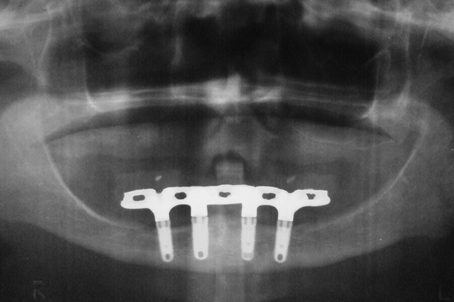 Fig. 11. Prótesis híbrida inmediata con 10 años de evolución y Rx Control a los 10 años.