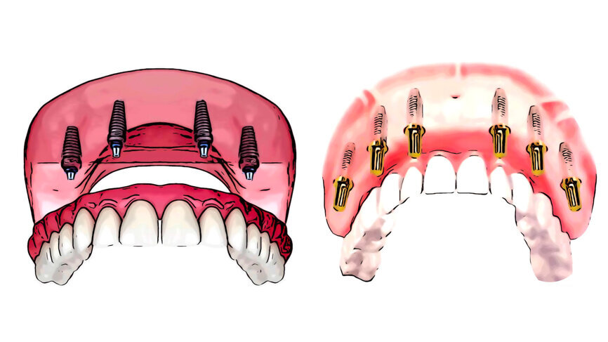 Fig. 3 : Prothèses All-On-4 et All-On-6.