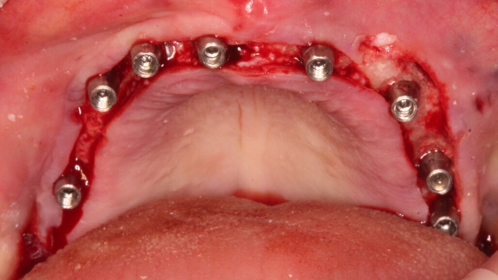 Protesi Toronto con tecnica CLIKSS