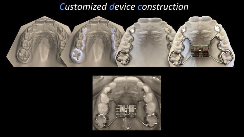 Fig. 3 - Esempio di procedure per la realizzazione “customized” di un Leaf Expander. Dalla scannerizzazione delle arcate al progetto 3D del dispositivo, la procedura è interamente digitale.