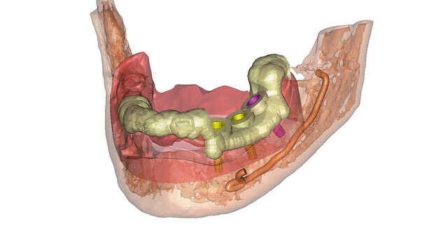 CAMLOG vereinbart Zusammenarbeit mit Materialise Dental und SICAT