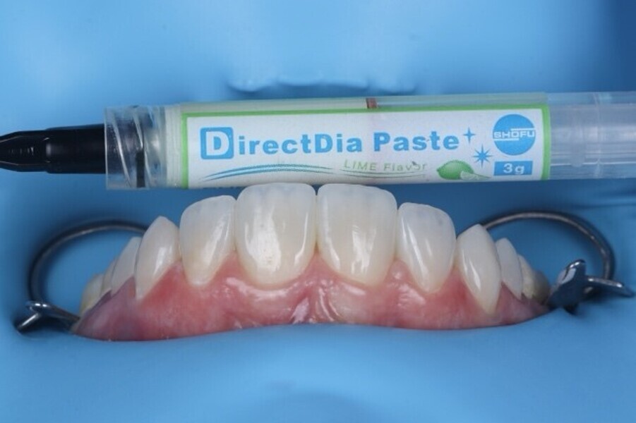 Fig. 3j: After finishing and polishing with composite finishing and polishing disks , diamond polishing paste was used for the final super polish.