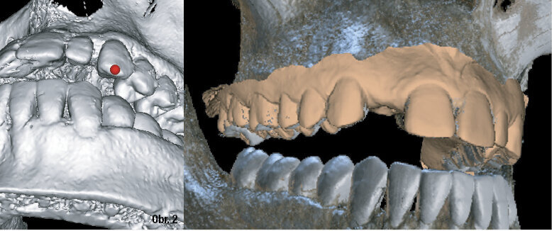 Obr. 2: Zkombinování CBCT a dat z intraorálních skenů usnadňuje podrobné, přesné předoperační plánování