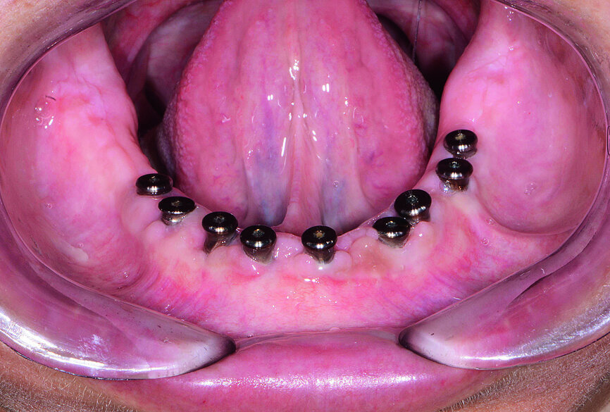 Fig. 18: Mandibular ridge four months post-op.