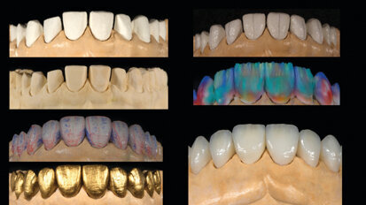 Flux de travail analogique vs. flux de travail numérique sur dix facettes maxillaires en céramique